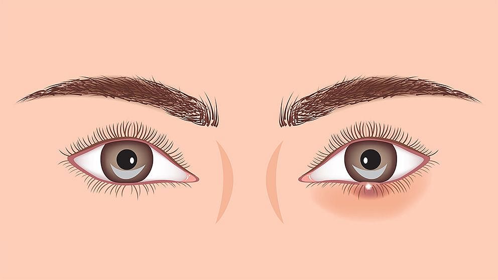 Illustration d'un œil sain et d'un œil avec orgelet