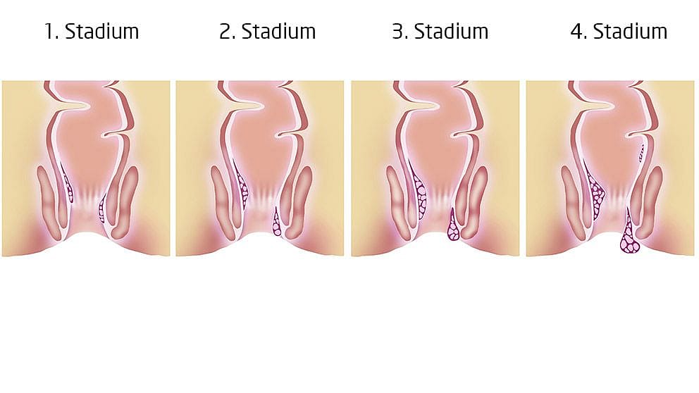 Illustration der 4 Stadien von Haemorrhoiden